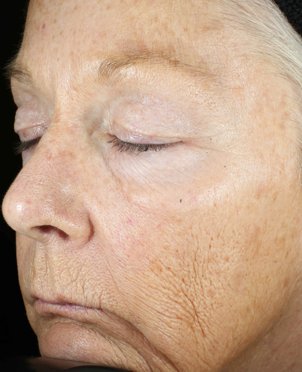 Wrinkle + Texture Repair - Image 3